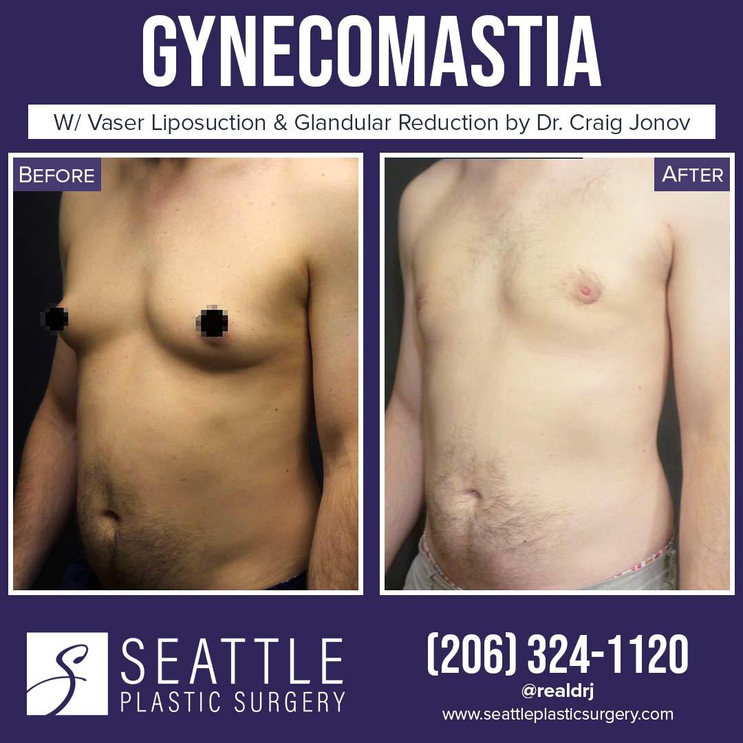 A Before and After Photo of a Plastic Surgery for Gynecomastia By Dr. Craig Jonov