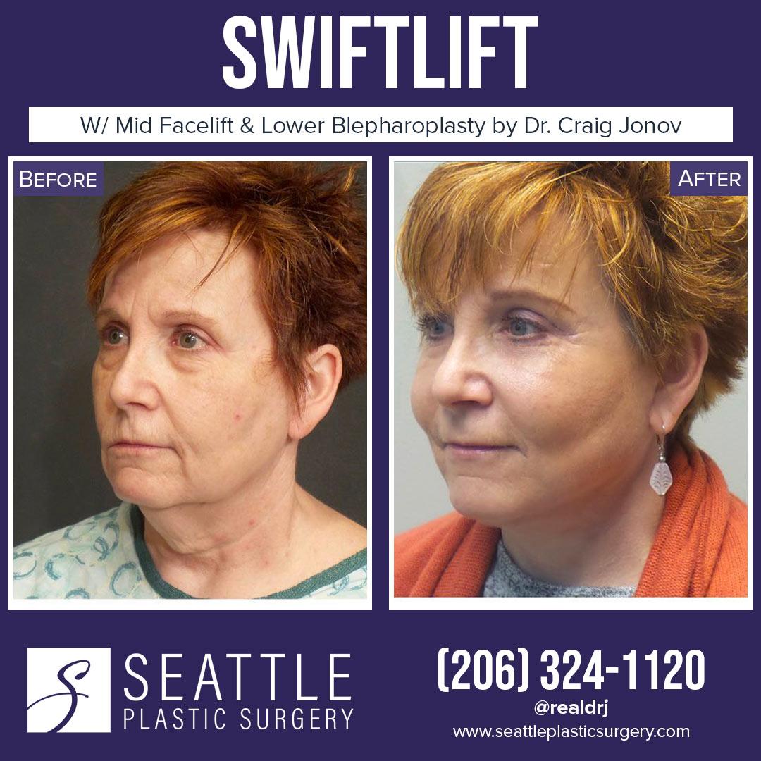 A Before and After photo of a Swiftlift Plastic Surgery by Dr. Craig Jonov