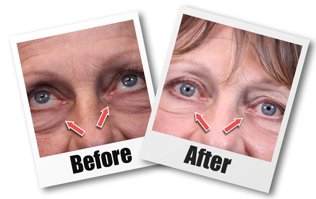 A Before and after picture of a patient who received a Blepharoplasty plastic surgery treatment