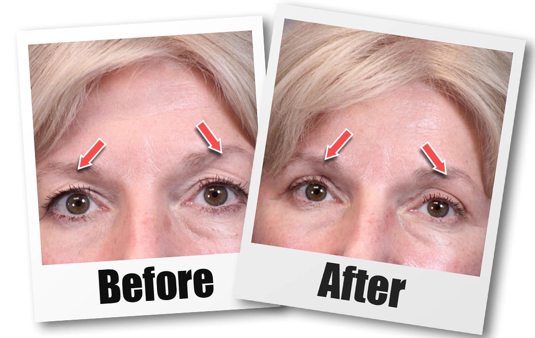 Before and after picture of a patient who received an Upper Blepharoplasty Seattle plastic surgery treatment