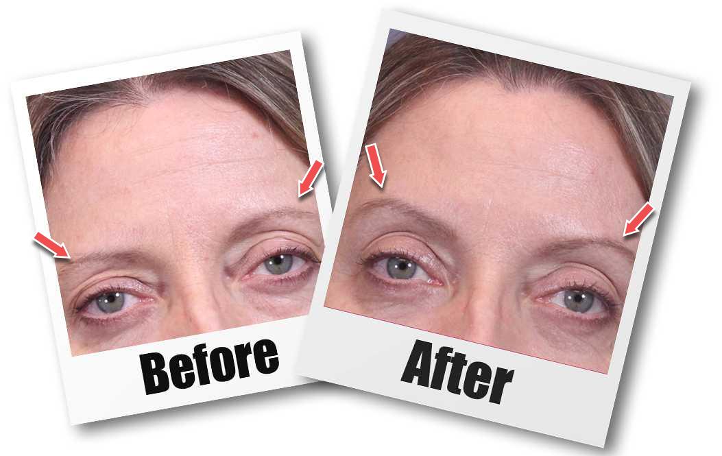 A Before and after picture of a patient who received a Brow Lift plastic surgery treatment