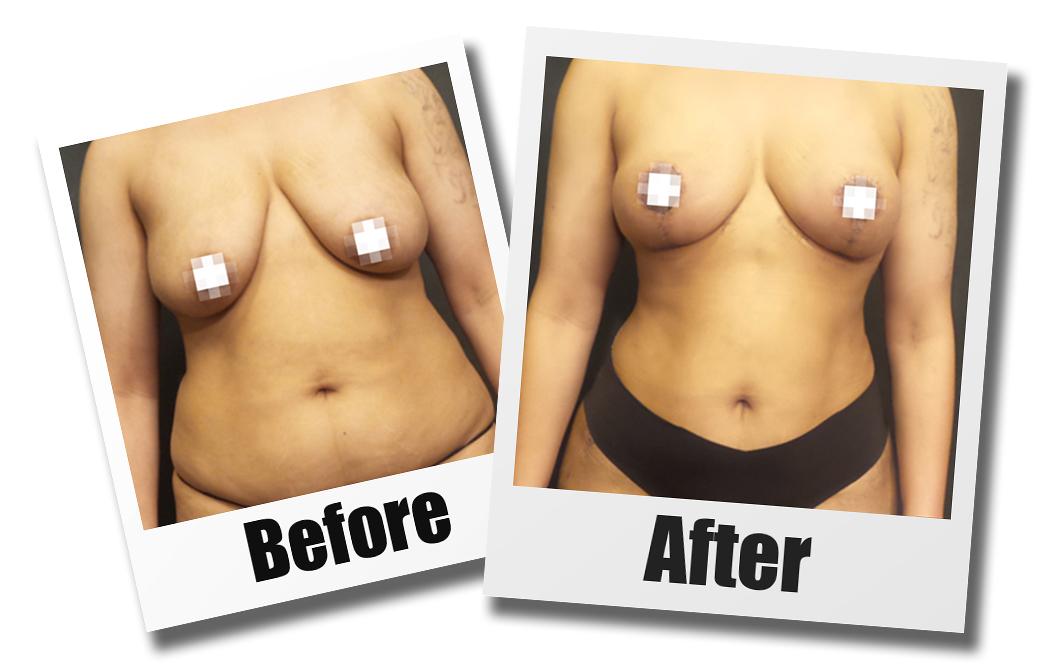 Before and After Photos of a patient who received a breast lift plastic surgery