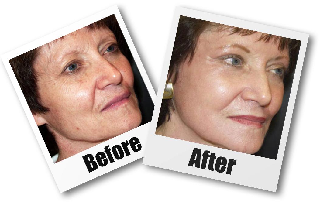 CO2 Laser Necklift - £300 Off!