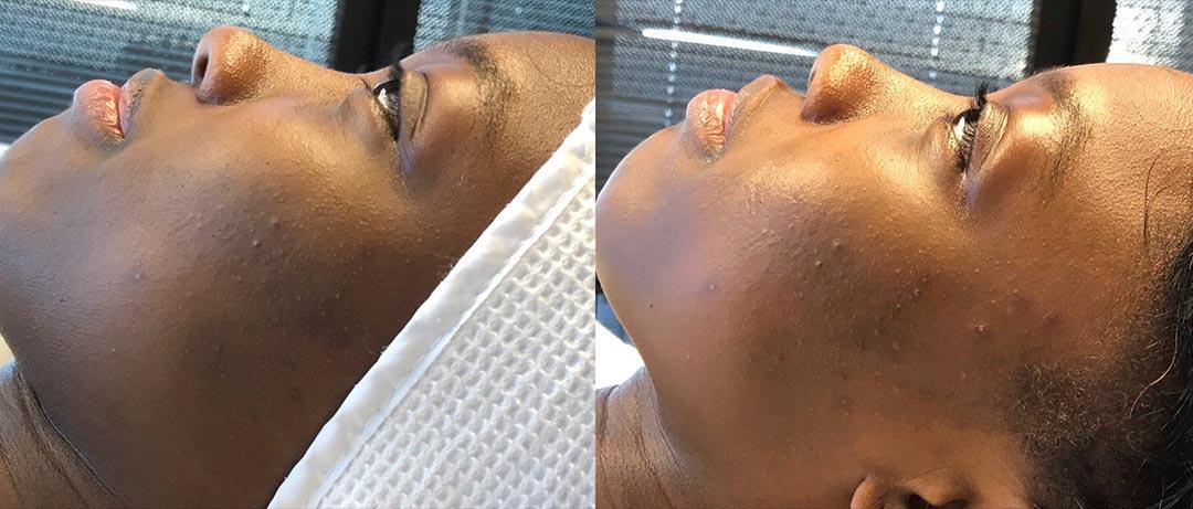 A Before and After Image Of a Patient Who Received a Dermaplaning Procedure At Seattle Plastic Surgery