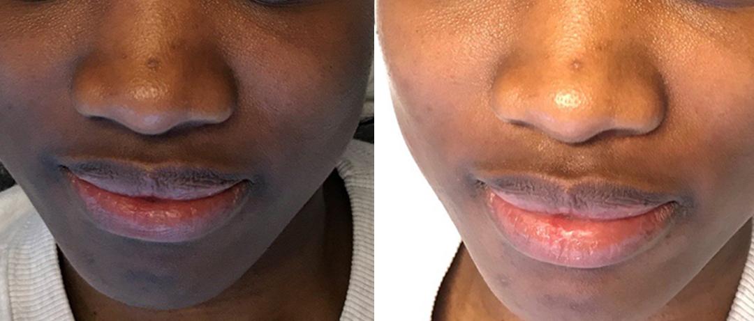 A Before and After Image Of a Patient Who Received a Dermaplaning Procedure At Seattle Plastic Surgery