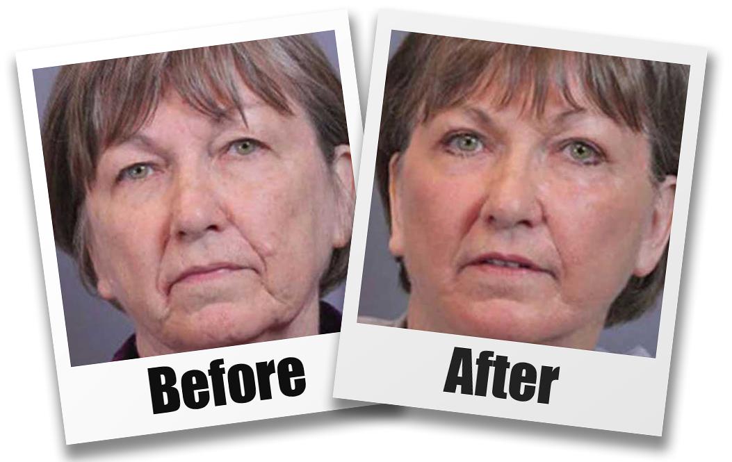 A Before and after picture of a patient who received a Face Lift plastic surgery treatment