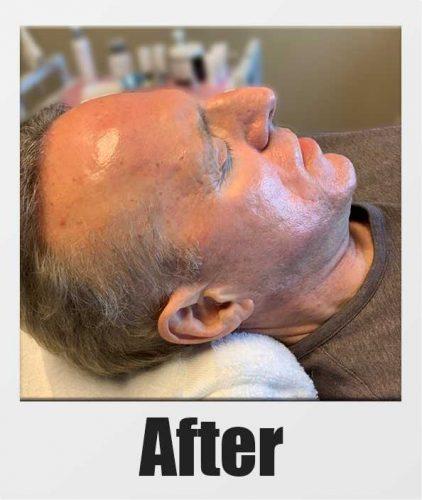 An After Photo of a patient who received a microneedling + PRP session in Kirkland Seattle Bellevue