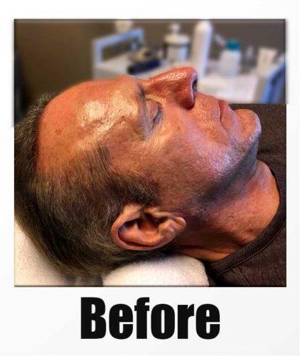 A Before Photo of a patient about to receive a microneedling + PRP session in Kirkland Seattle Bellevue