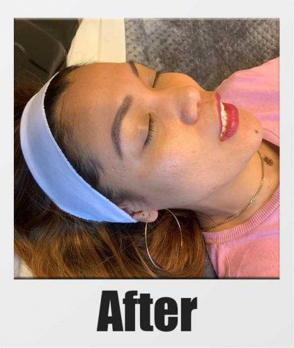 An After Photo of a patient who received a microneedling + PRP session in Kirkland Seattle Bellevue