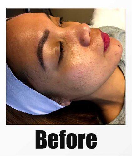 A Before Photo of a patient about to receive a microneedling + PRP session in Kirkland Seattle Bellevue