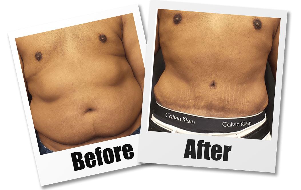 A Before and After photo of a Male Abdominoplasty Surgery With Liposuction by Dr. Craig Jonov