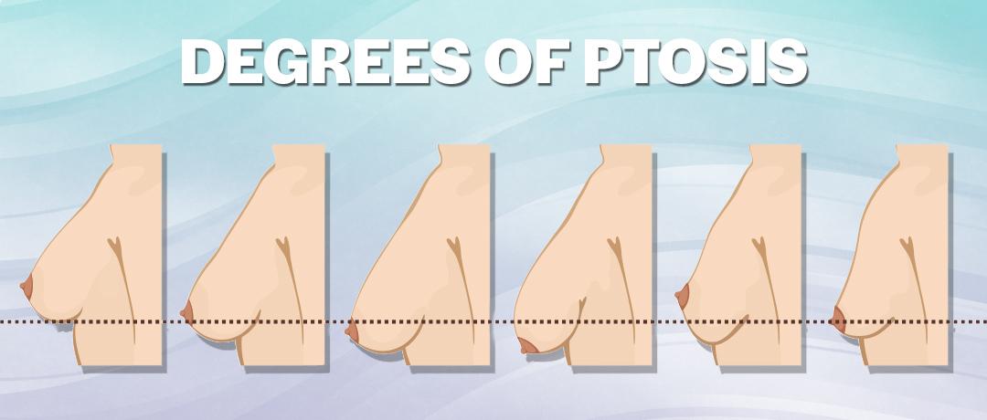 A Chart Demonstrating The Degrees of Ptosis