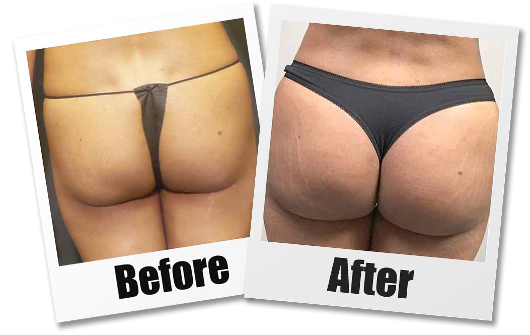 A Before and After photo of a Brazilian Butt Lift Plastic Surgery With Liposuction by Dr. Craig Jonov