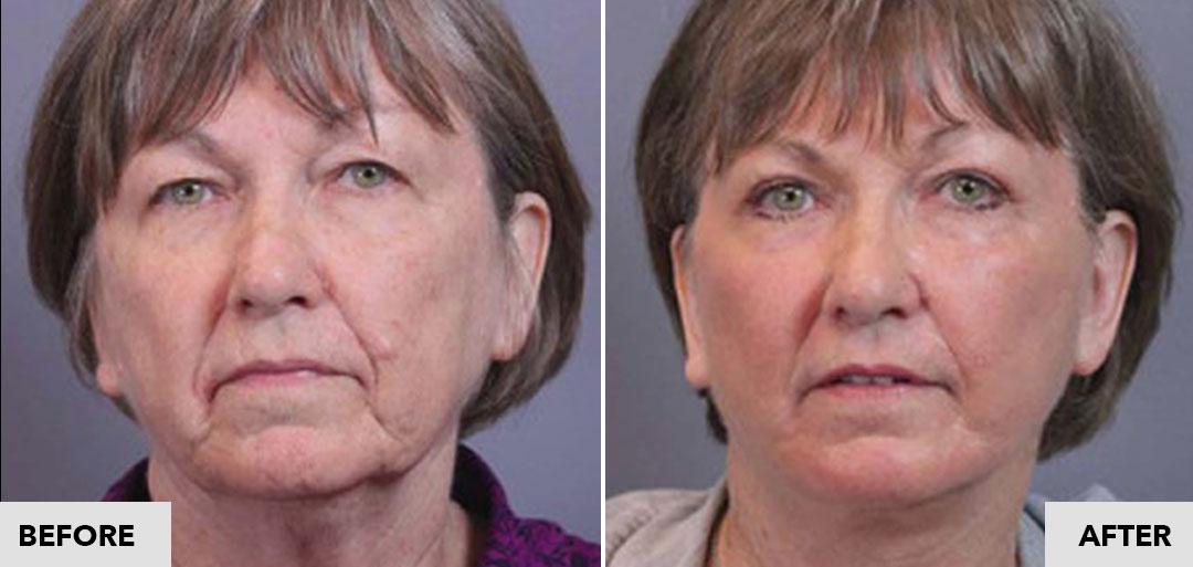 Before and After image of a facelift by Dr. Santos in Seattle Plastic Surgery