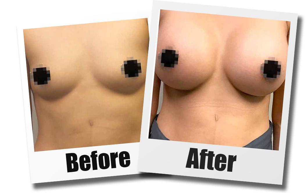 A Before and After photo of a Breast Augmentation Plastic Surgery by Dr. Craig Jonov