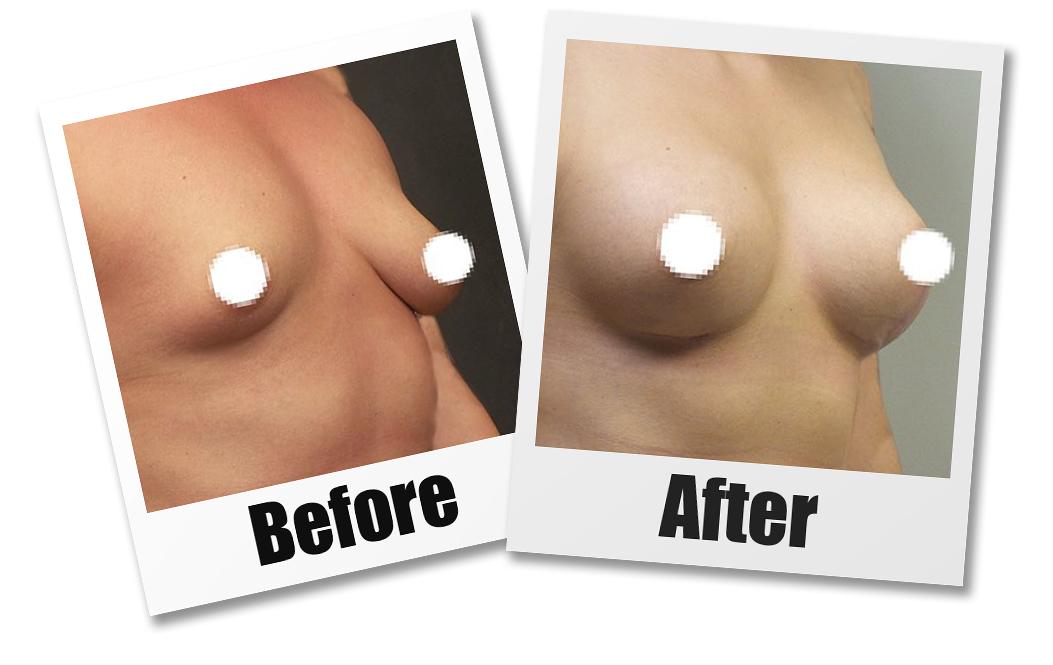 A Before and After photo of a Breast Augmentation With Lift Plastic Surgery by Dr. Craig Jonov