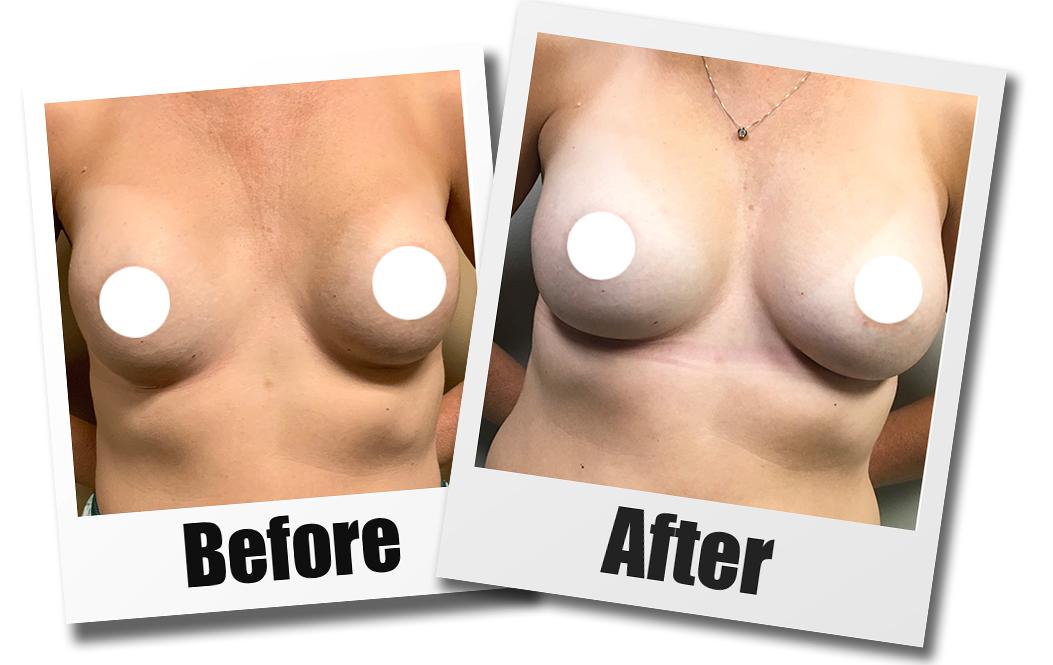 A Before and After photo of a Breast Revision Plastic Surgery by Dr. Craig Jonov