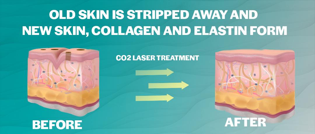 A sample of skin showing new collagen and elastin growth after a co2 laser treatment