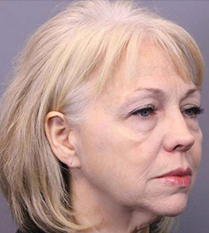 Image of a before facelift procedure