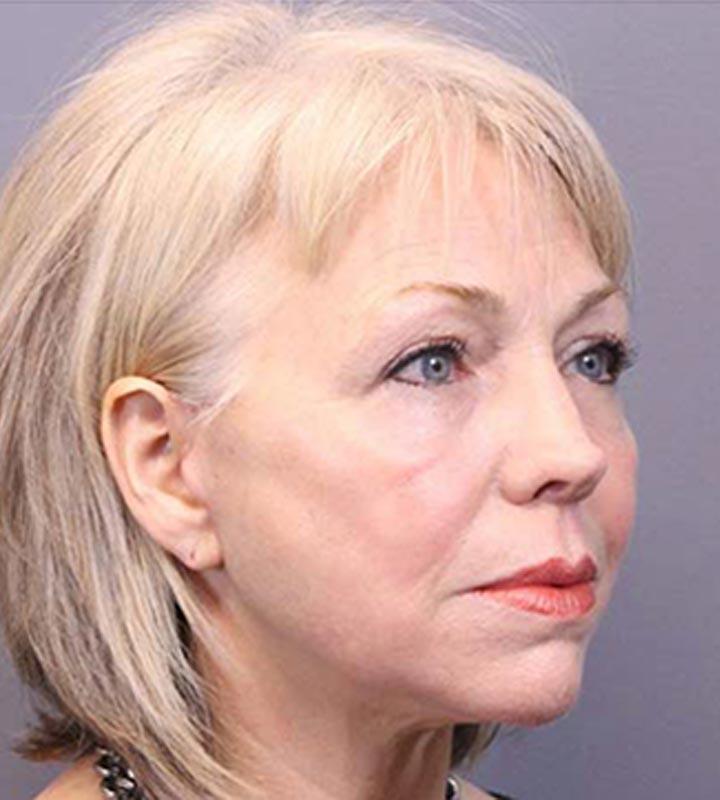 Image of an after facelift procedure