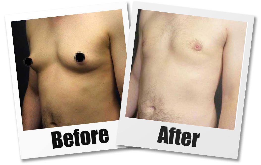 Male Breast Reduction Surgery Gynecomastia Rhode Island RI