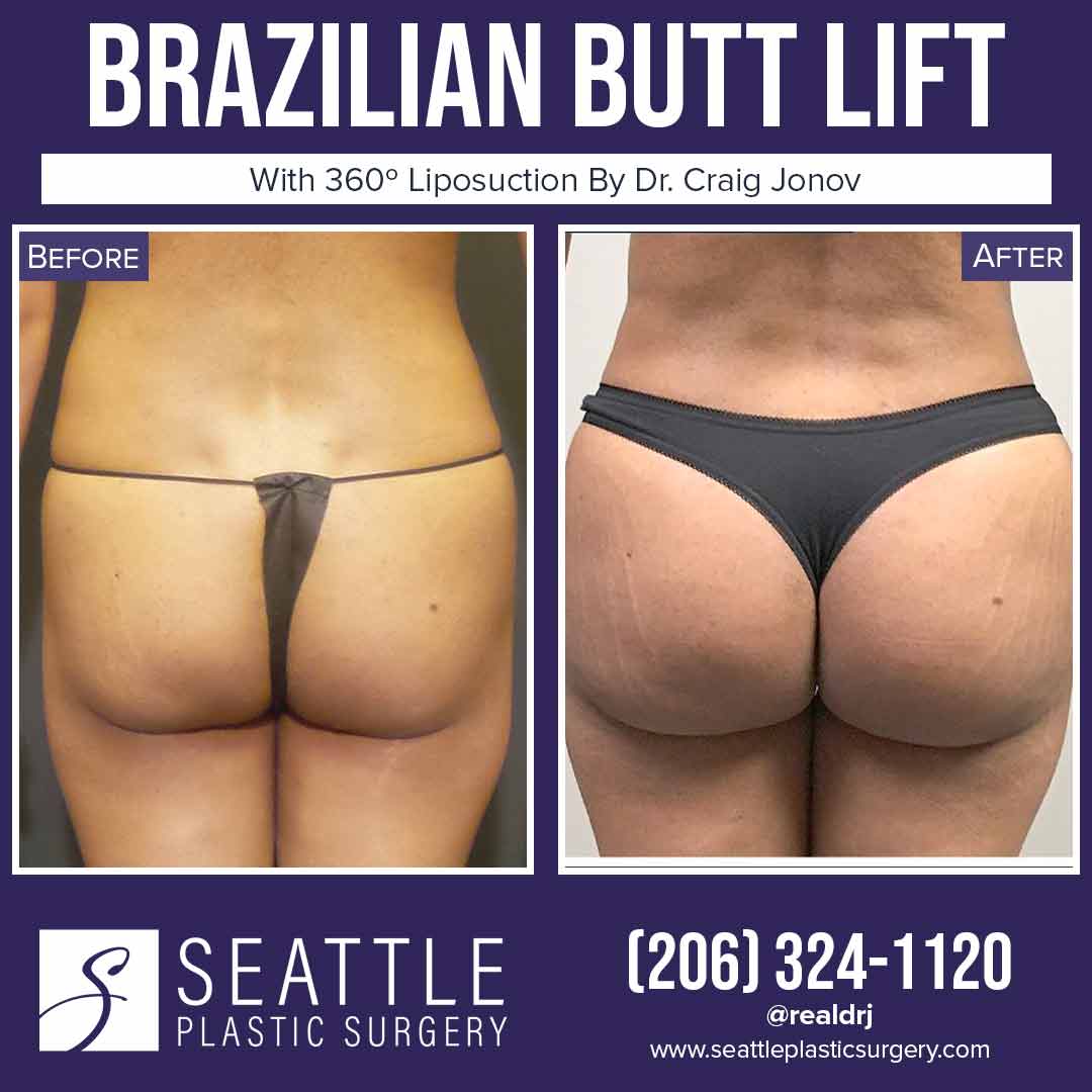 A Before and After photo of a Brazilian Butt Lift Plastic Surgery With Liposuction by Dr. Craig Jonov
