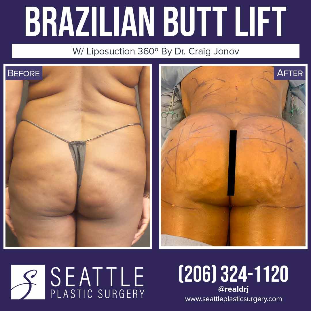 A Before and After photo of a Brazilian Butt Lift Plastic Surgery With Liposuction by Dr. Craig Jonov