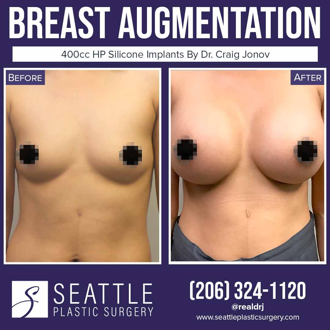 A Before and After photo of a Breast Augmentation Plastic Surgery by Dr. Craig Jonov