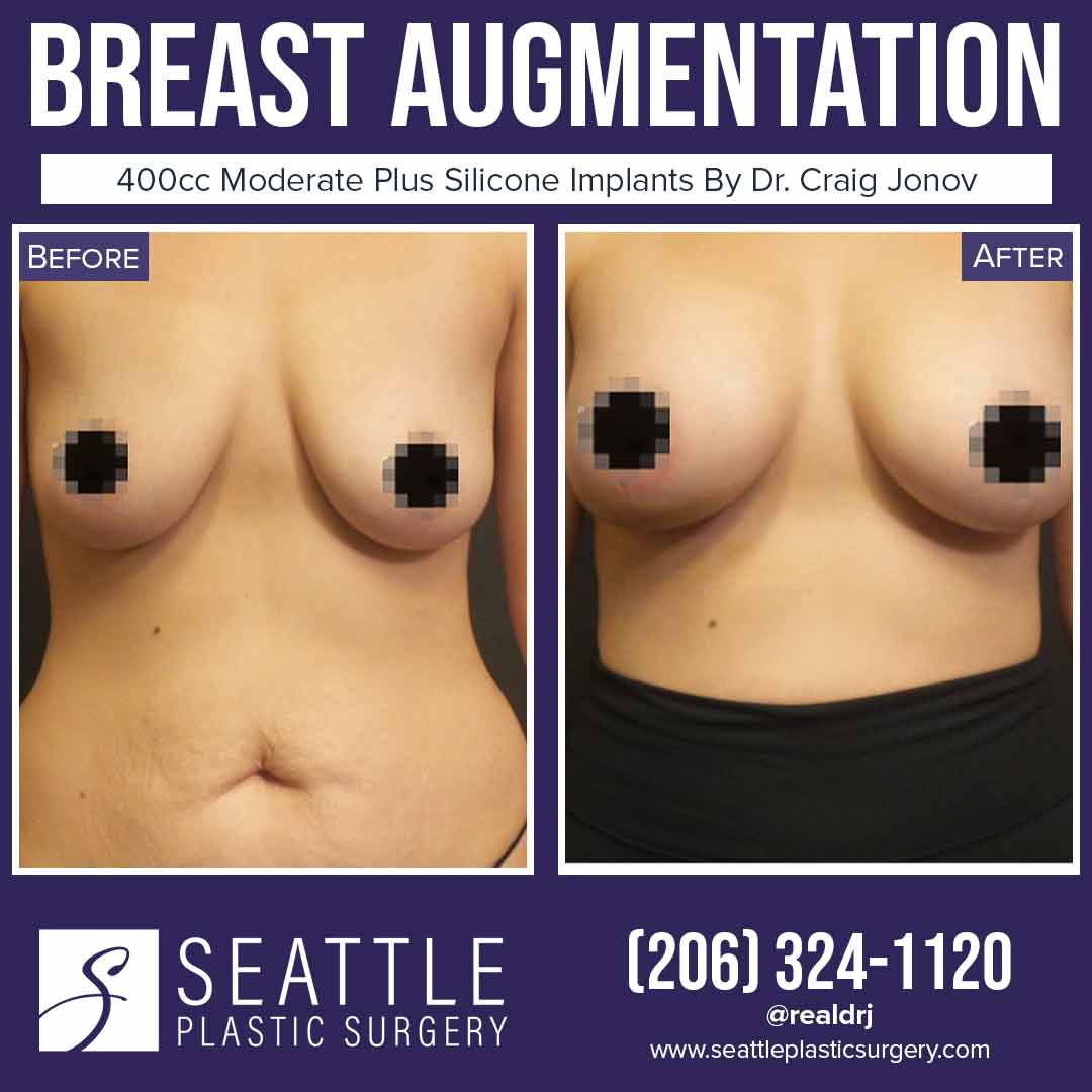 A Before and After photo of a Breast Augmentation Plastic Surgery by Dr. Craig Jonov