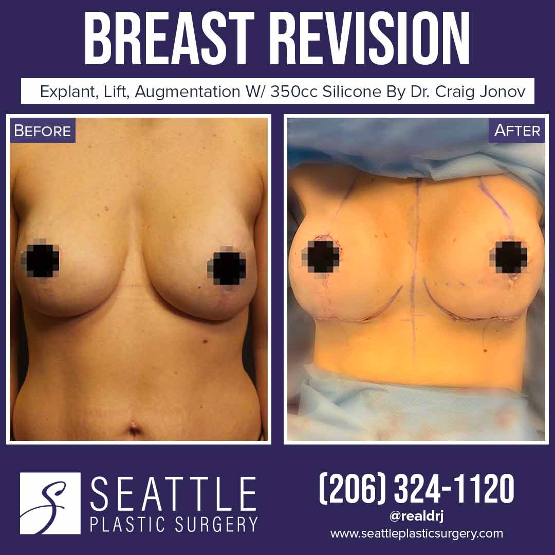 A Before and After photo of a Breast Revision Plastic Surgery by Dr. Craig Jonov