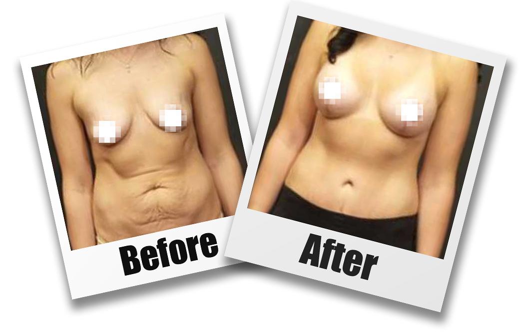 A Before and After photo of a Breast Augmentation With Lift Plastic Surgery by Dr. Craig Jonov