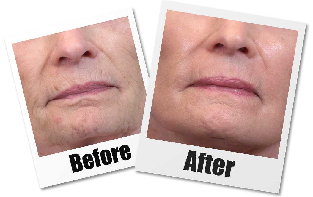 Facial Fat Transfer Seattle, Fat Transfer Cost