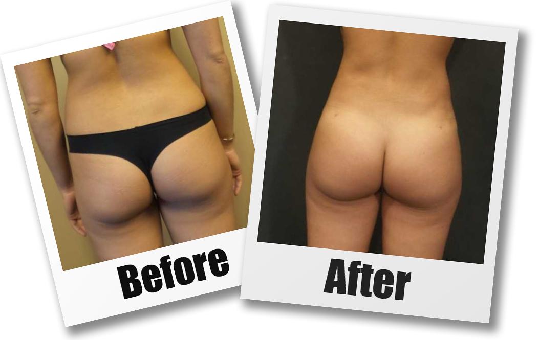 A Before and After photo of a Liposuction by Dr. Craig Jonov