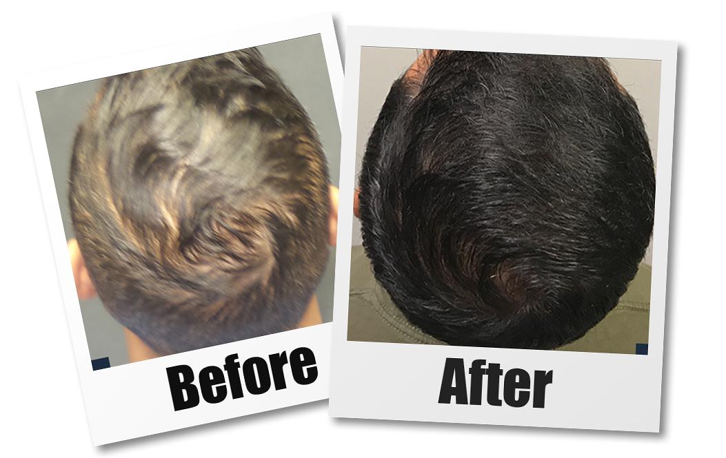 A Before and after of a patient who received a PRP hair restoration