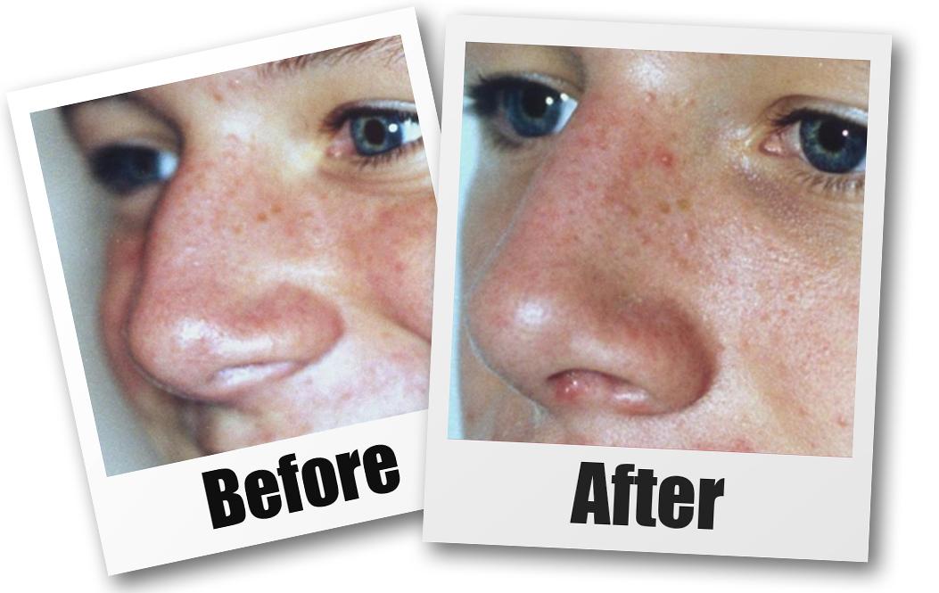 A Before and after picture of a patient who received a Rhinoplasty plastic surgery treatment