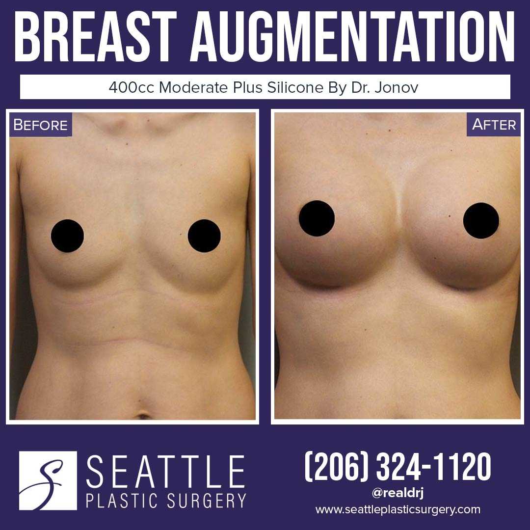 A Before and After photo of a Breast Augmentation Plastic Surgery by Dr. Craig Jonov