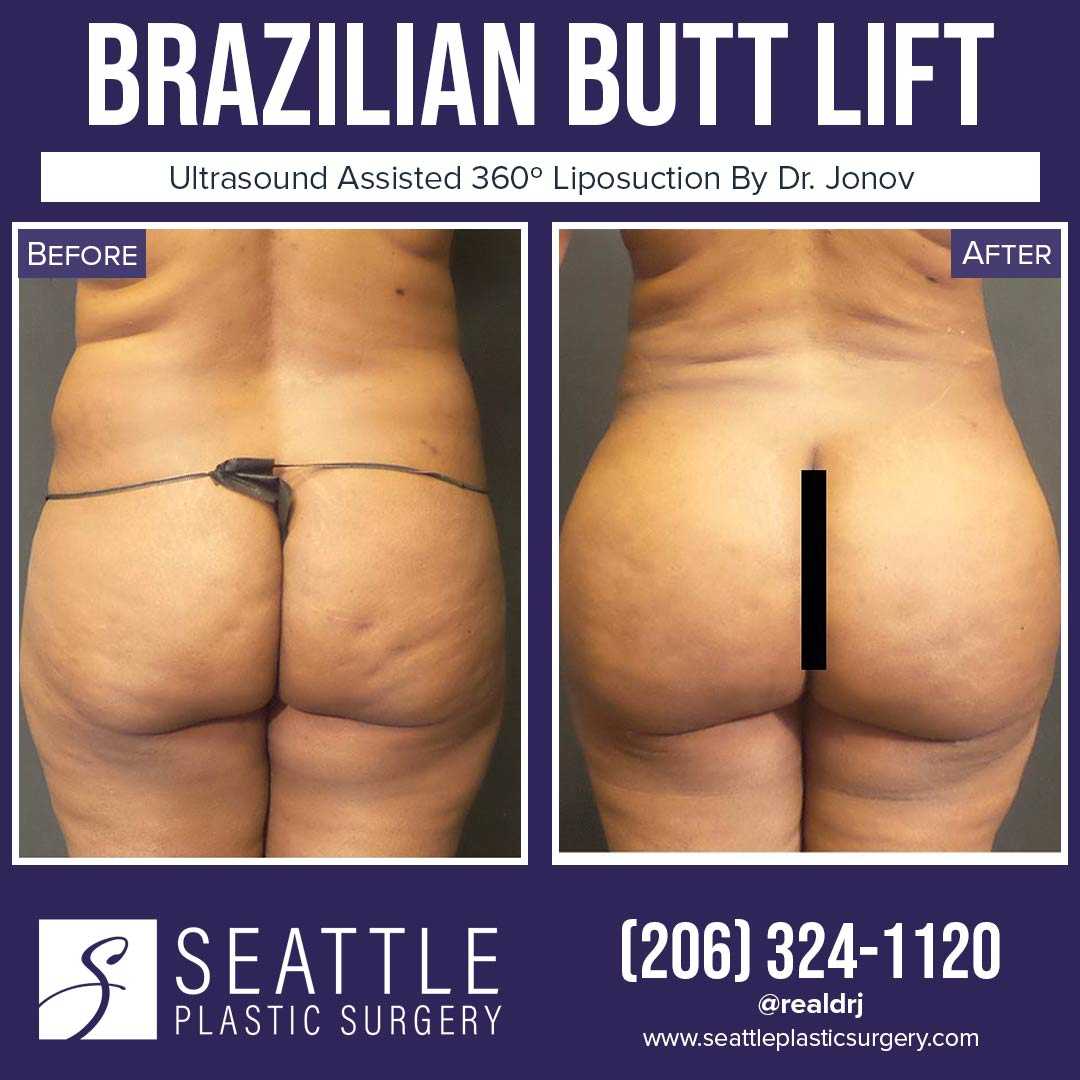 A Before and After photo of a Brazilian Butt Lift Plastic Surgery With Liposuction by Dr. Craig Jonov