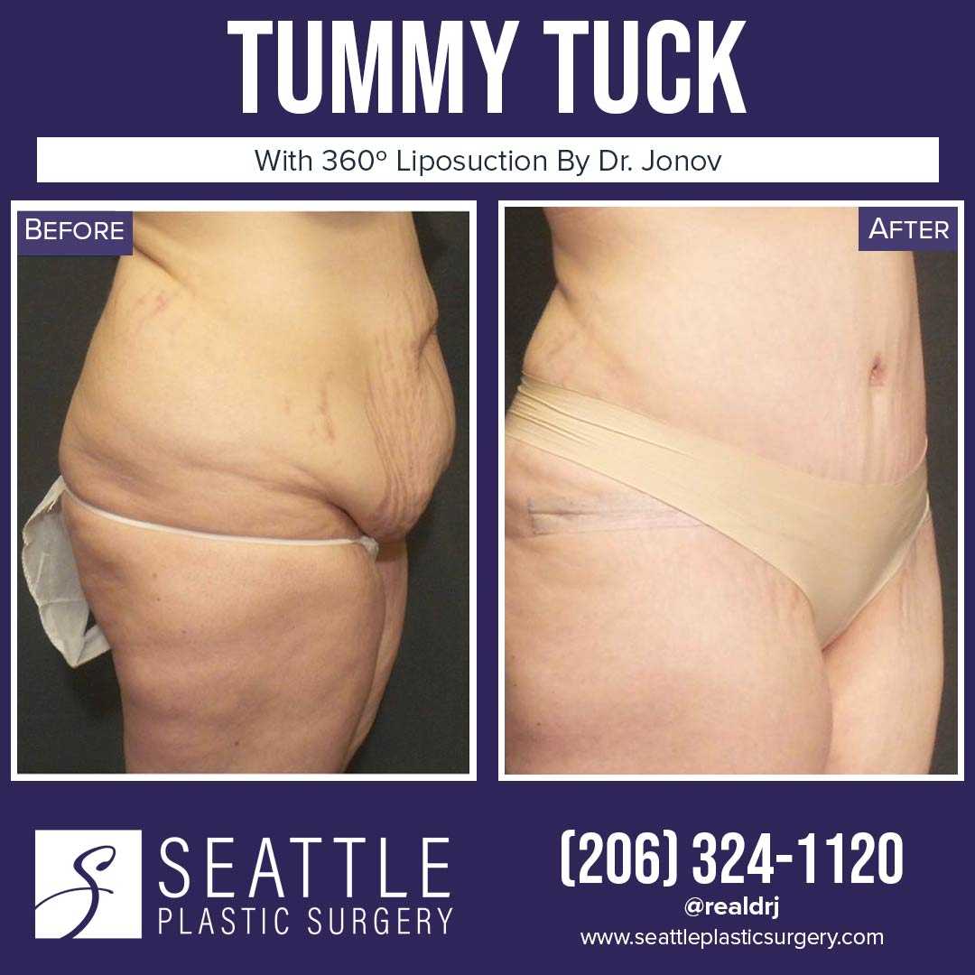 A Before and After photo of a Tummy Tuck Plastic Surgery by Dr. Craig Jonov