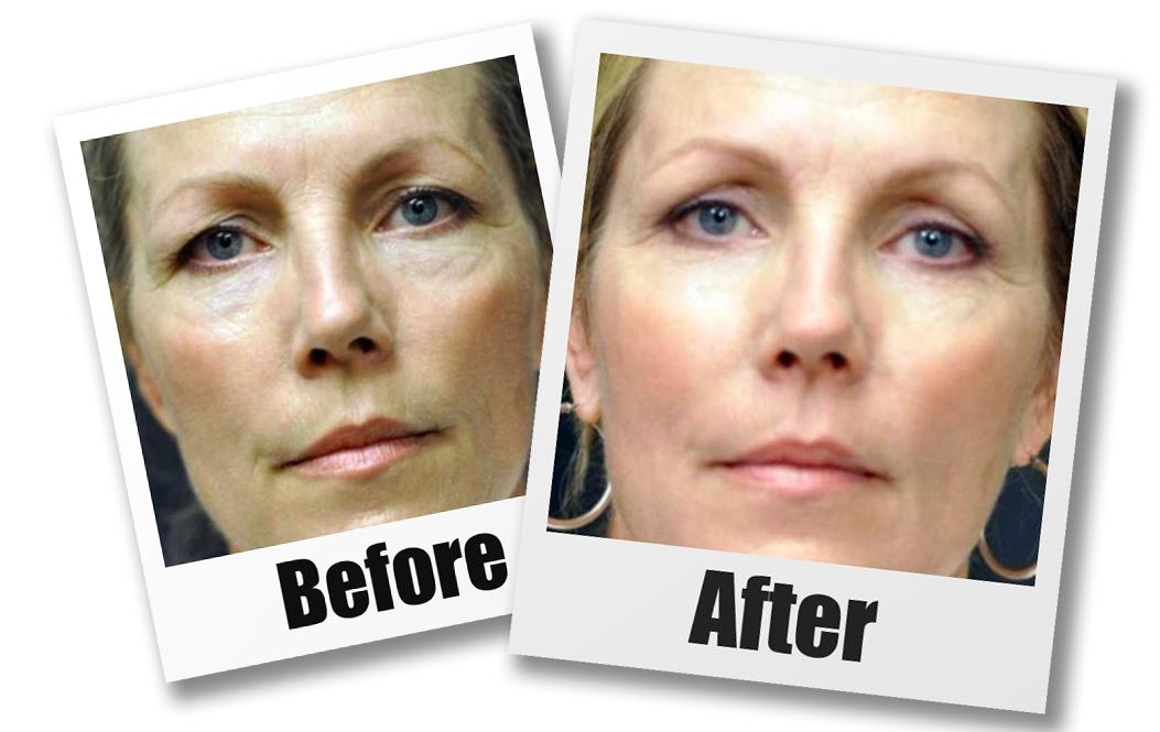 A Before and after picture of a patient who received a Blepharoplasty plastic surgery treatment