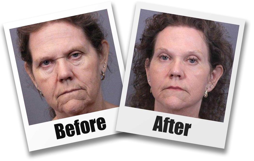 A Before And After Image of A Patient who Received a Browlift Plastic Surgery