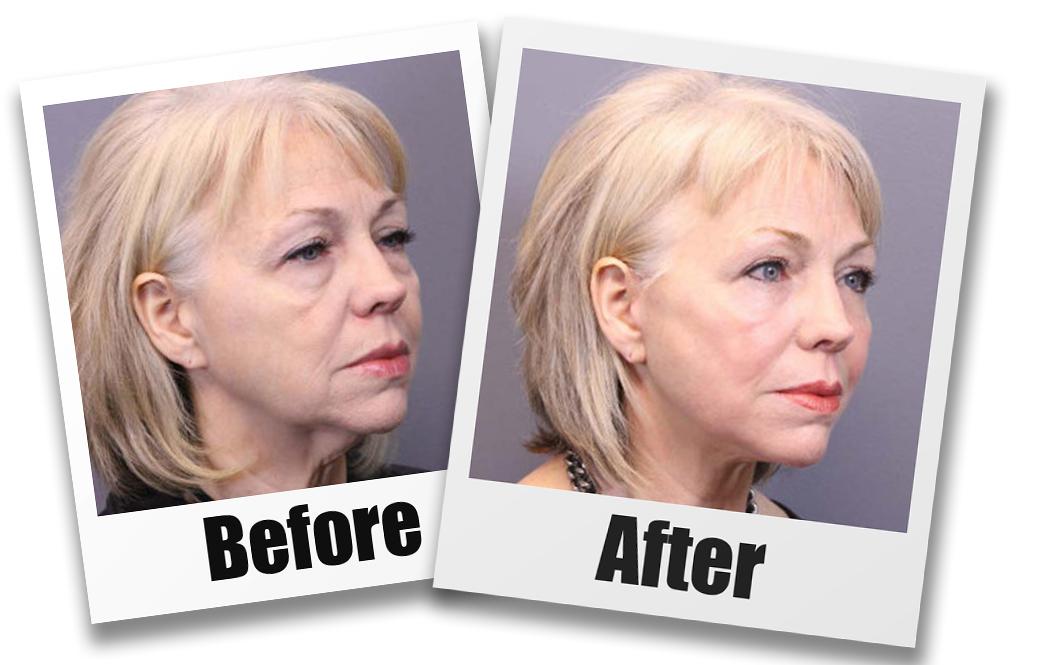 A Before and after picture of a patient who received a Face Lift plastic surgery treatment