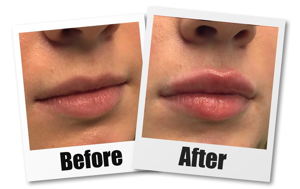 a before and after photo of a patient who received a lip filler treatment