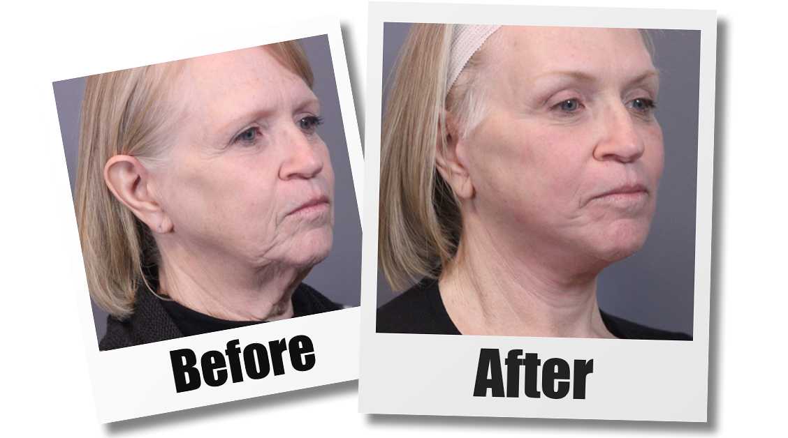 A Before and After Photo of a patient who received a mini facelift plastic surgery