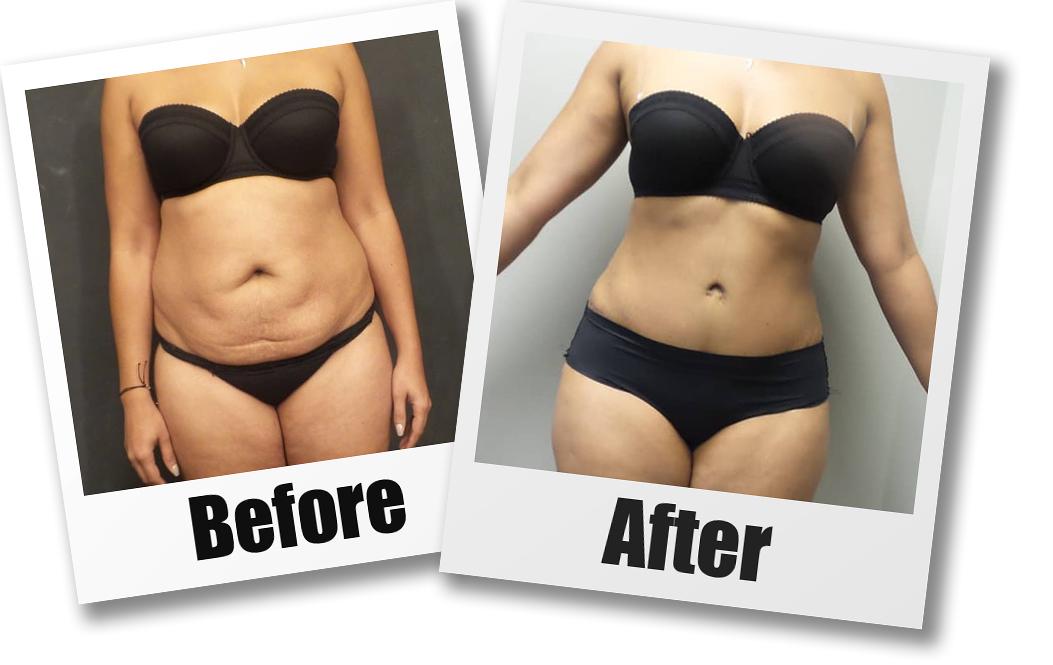 A Before And After Photo Of A Patient Who Received A Tummy Tuck Plastic Surgery By Dr Craig Jonov