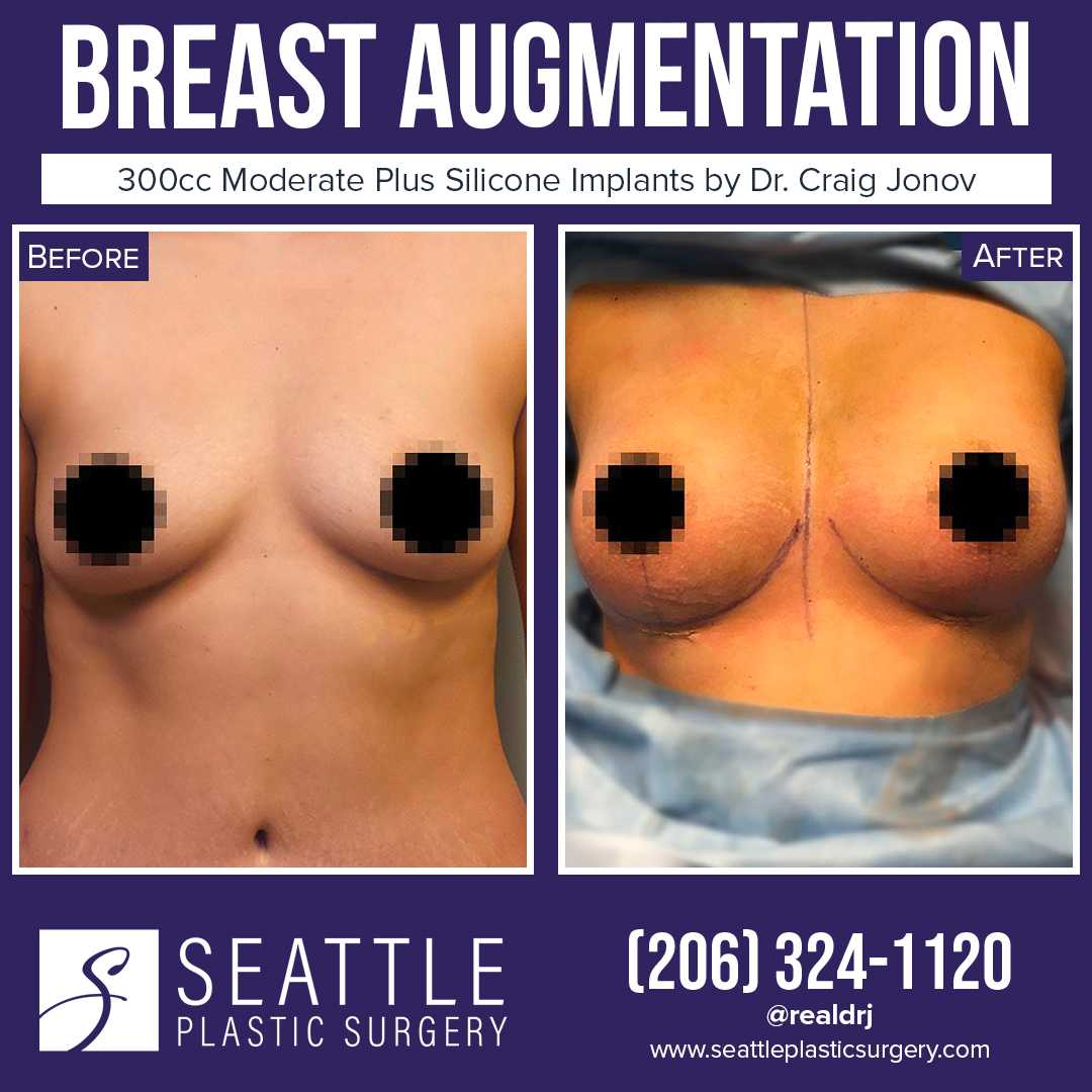 A Before and After photo of a Breast Augmentation Plastic Surgery by Dr. Craig Jonov