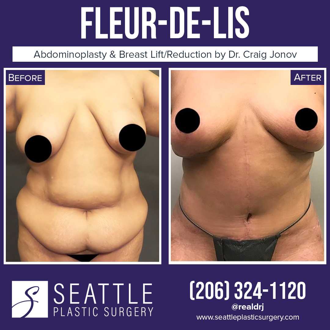 A Before and After photo of a Fleur-De-Lis Surgery With Liposuction by Dr. Craig Jonov
