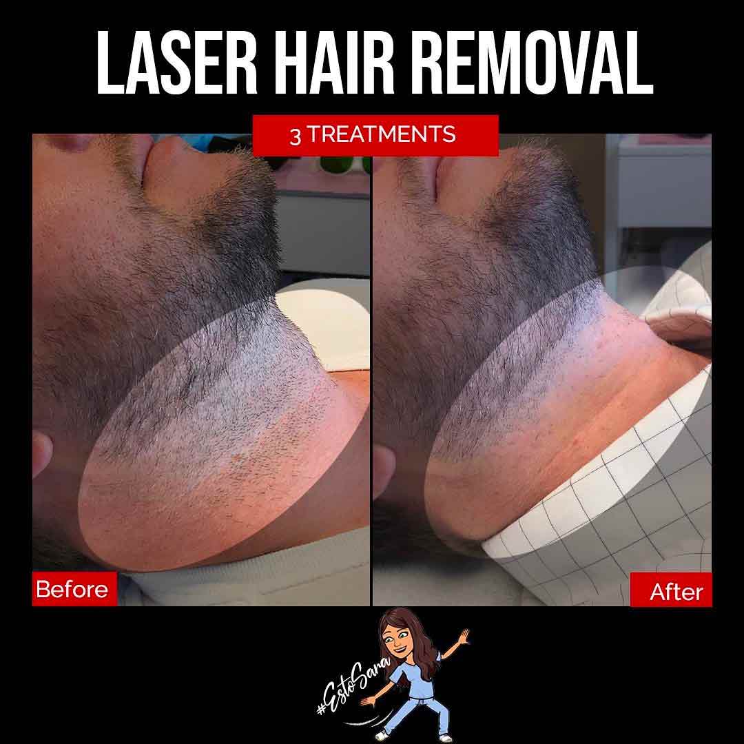 A Before and After Set Of Photos of a patient who received a Laser Hair Removal treatment