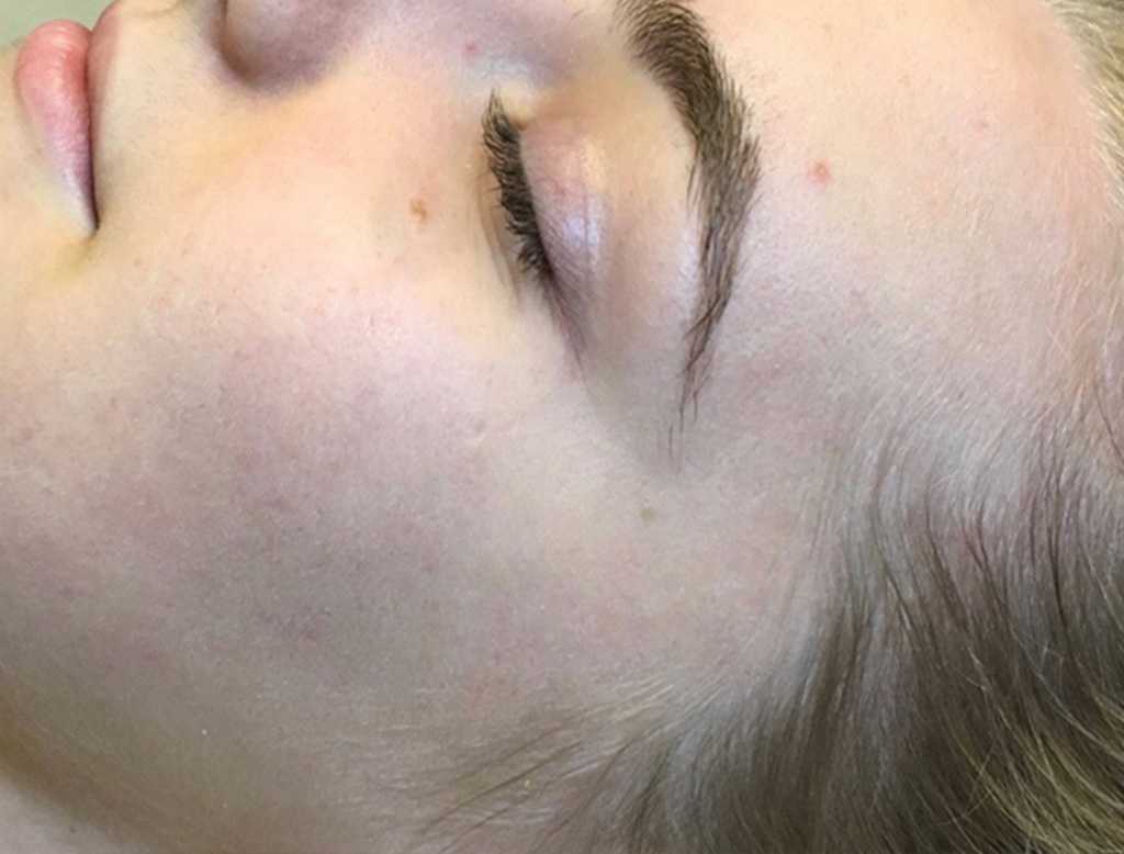 An After photo of a chemical peel in Seattle and Tacoma
