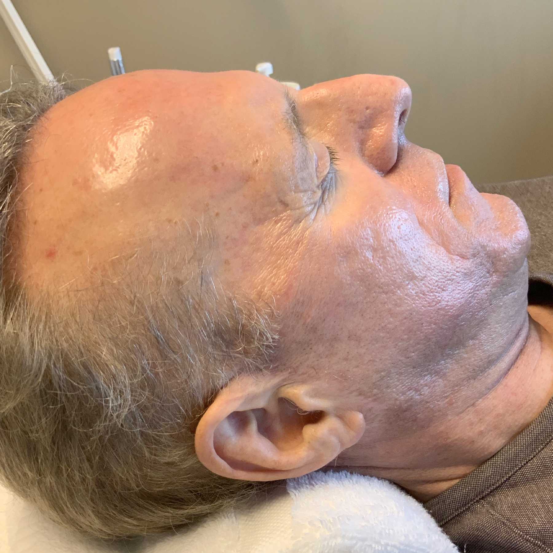 An After photo of microneedling in Seattle and Tacoma