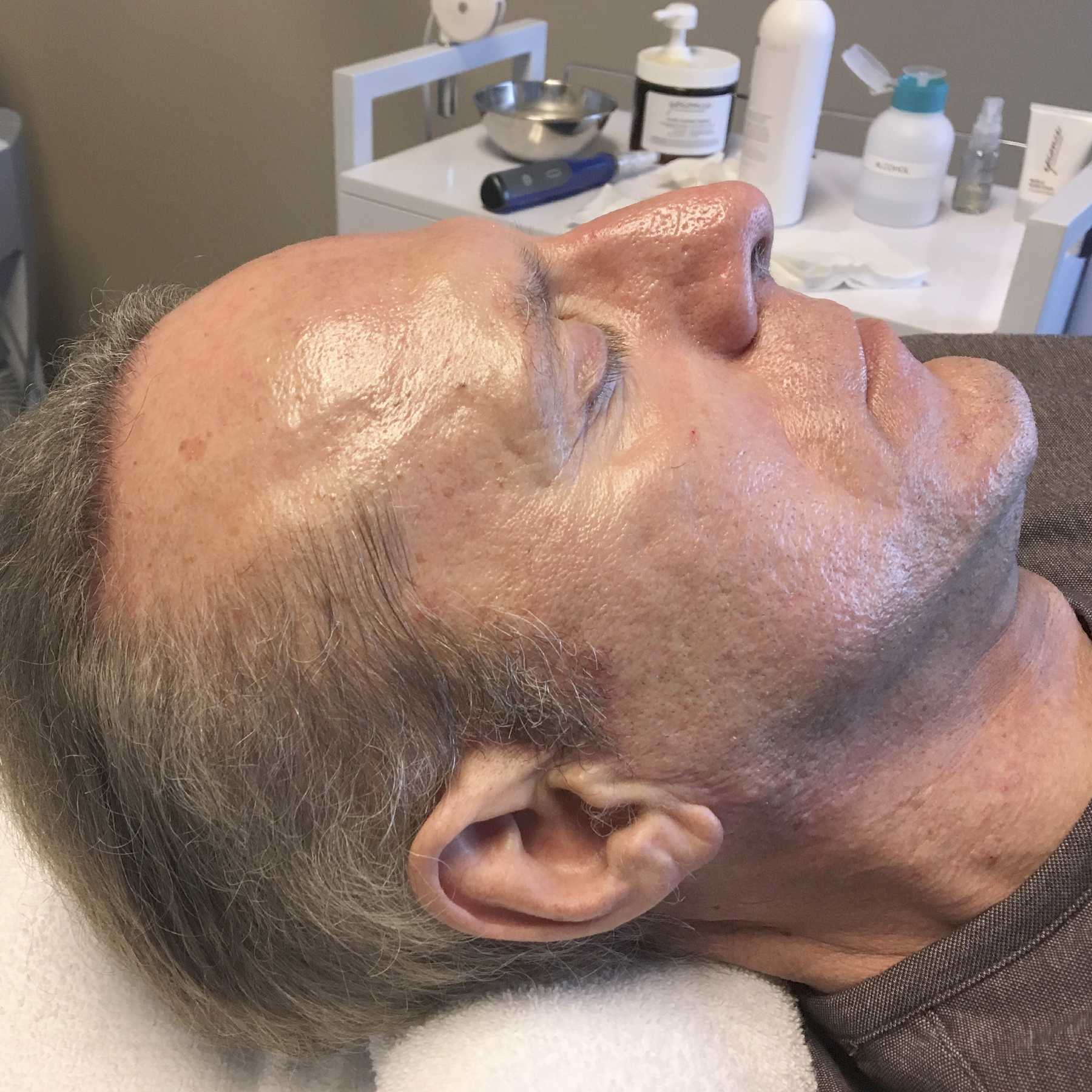 A Before photo of a microneedling procedure in Seattle and Tacoma